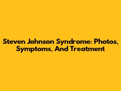 Steven Johnson Syndrome: Photos, Symptoms, And Treatment