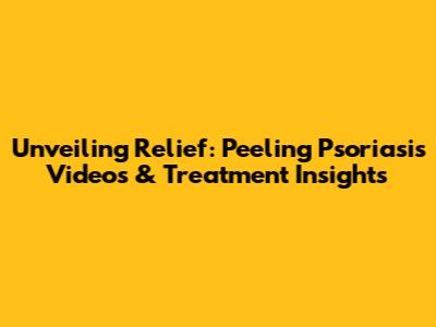 Unveiling Relief: Peeling Psoriasis Videos & Treatment Insights